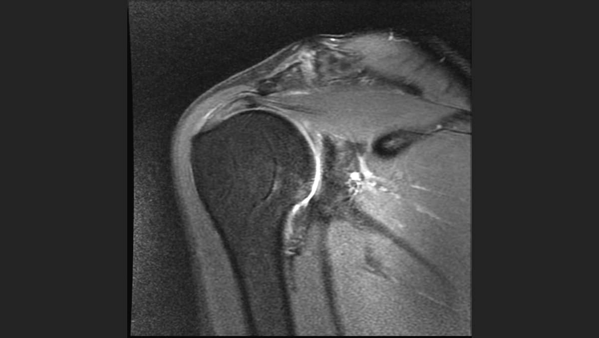 Rotator cuff shop injury